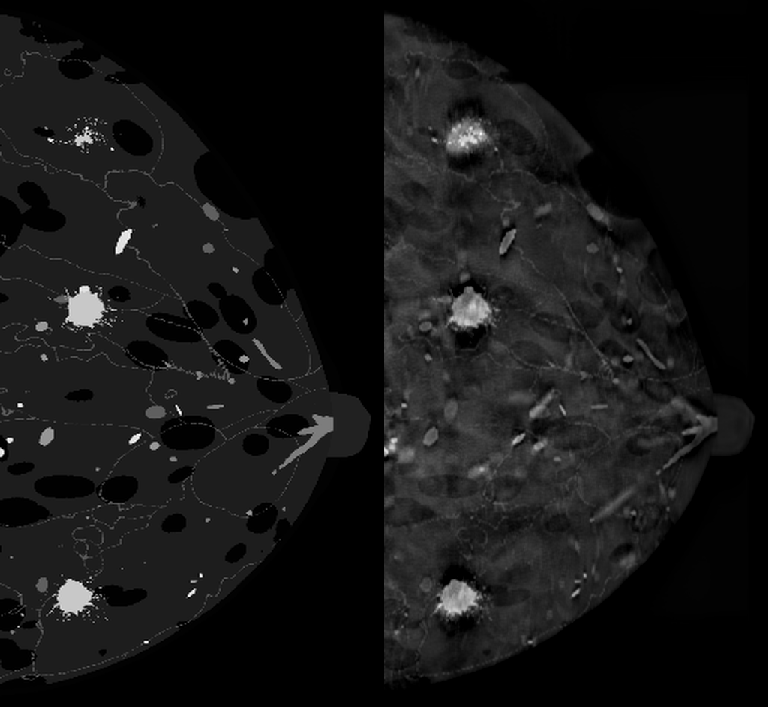 SART rekonstrüksiyon — phantom (sol) ve sonuç (sağ)